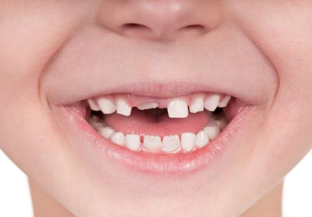 کشیدن دندان در کودکان